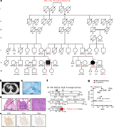 Tuberculosis in otherwise healthy adults with inherited TNF deficiency