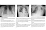 Generative AI model shows promise in chest x-ray study