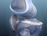 Many people unaware that knee and groin pain could signal hip problems