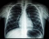 Digital health outreach can improve lung cancer screening