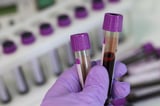 Early blood test can predict survival in men newly diagnosed with metastatic prostate cancer, clinical trial finds