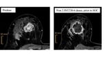 Intensity Therapeutics Reports INVINCIBLE-4, Presurgical Triple-Negative Breast Cancer Study Update