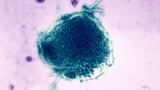 Pennsylvania reports fourth measles-related death, the most in US in decades