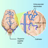 Less invasive brainwave recording breakthrough