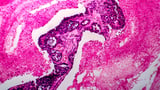 FDA approves Verastem’s ovarian cancer treatment