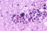 North Carolina teen critically ill with rare amoeba brain infection