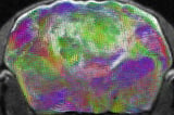 Researchers create advanced model for studying brain development, disorders