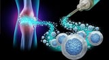 Extracellular Vesicles for Treating Arthritis