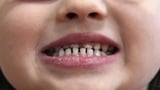 FDA and RFK Jr. aim to remove ingestible fluoride products used to protect kids' teeth | AP News