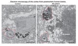 Alzheimer's progression tied to stress-induced microglial lipid release