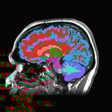 A single brain scan can tell how fast you're aging