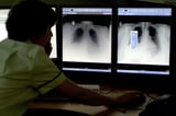 World-first test could detect early signs of lung cancer