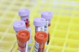 Liquid biopsy blood test shows superior sensitivity in detecting HPV-associated head and neck cancers
