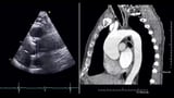 Indexed CTA Measures Sharpen Risk Prediction in Ascending Aortopathy