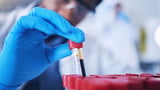 Long COVID Biomarker Found in Blood of Affected Patients