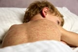 measles June update tips