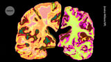 New hope for Alzheimer’s: lithium supplement reverses memory loss in mice