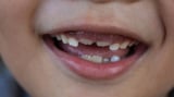 FDA moves to ban fluoride supplements for kids, removing a key tool for dentists