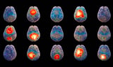 Israeli Startup Uses AI to Diagnose Brain Disorders in 15 Minutes