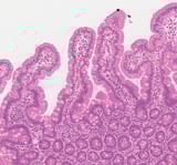 AI is as good as pathologists at diagnosing celiac disease, study finds