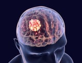 Mapping genetic activity offers new clues for personalized cancer treatment