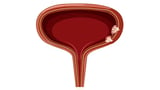 Bladder Cancer Survival Better With Nivolumab Than Placebo in New Analysis