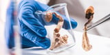 Psilocybin-assisted therapy shows promise for veterans with severe, treatment-resistant PTSD