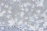 Bowel cancer in young people is on the rise. This bacterial toxin could be the cause