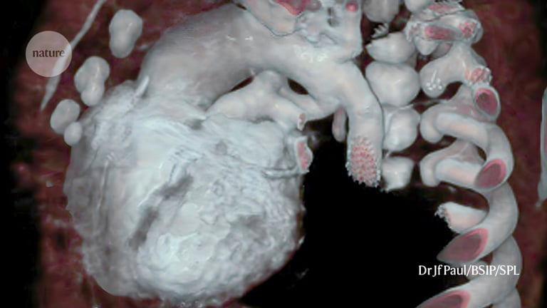 Groundbreaking Partial Heart Transplant Saves Baby's Life at Duke University