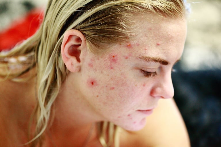 Engineered Skin Bacterium: A Potential Game-Changer in Acne Treatment