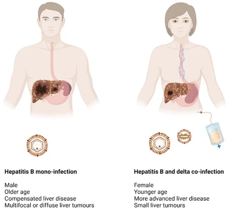 Hepatitis Delta Virus Coinfection Triples Liver Cancer Risk in Hepatitis B Patients