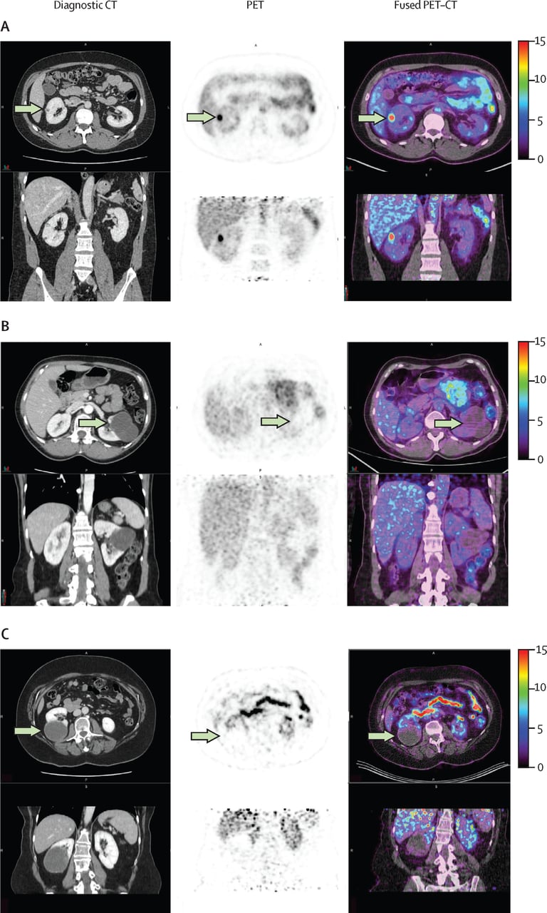 Breakthrough Imaging Technique from UCLA Accurately Detects Kidney Cancer, Potentially Revolutionizing Diagnostics