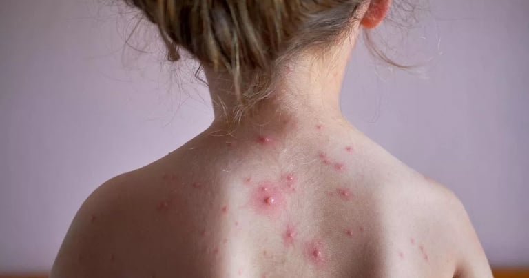 UK to Add Chickenpox Vaccine to NHS Schedule by 2026, Aiming to Protect 500,000 Children Annually