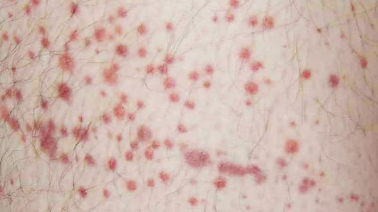 EMA Approves Rilzabrutinib for Chronic ITP in Adults Resistant to Standard Treatments