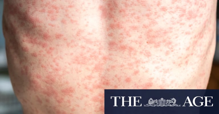 Victoria Faces Worst Measles Outbreak in a Decade: Vaccine Hesitancy Fuels Community Spread