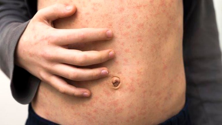 Measles Alert in WA: Travelers and FIFO Workers Urged to Vaccinate Amid New Cases