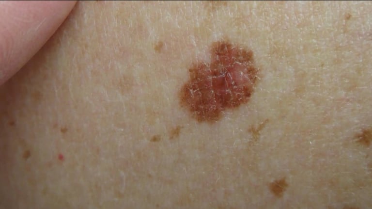 Personalized mRNA Vaccine Shows Promise in Melanoma Trial, Cutting Metastasis Risk by 60%