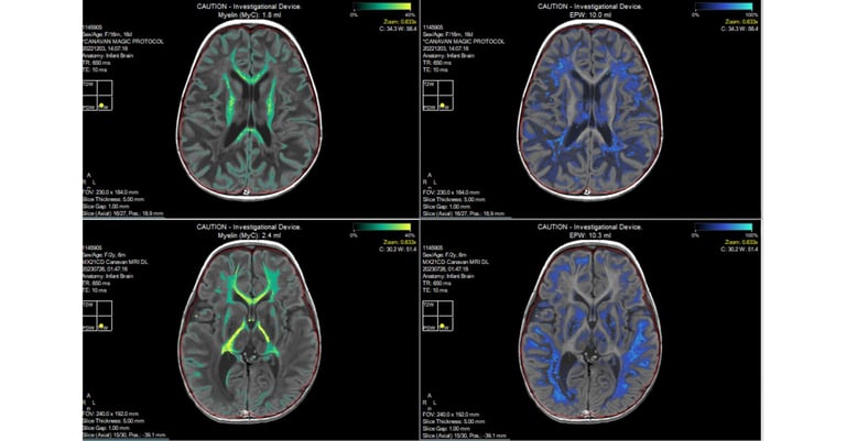 Myrtelle's Gene Therapy Shows Promising Results for Canavan Disease in Early Trials