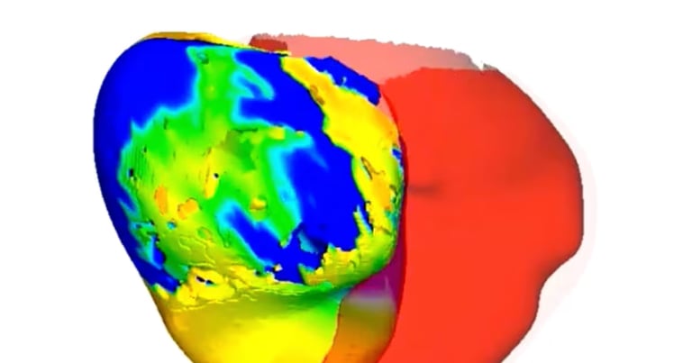 Digital Twins Revolutionize Heart Ablation, Slashing Procedure Time and Enhancing Precision