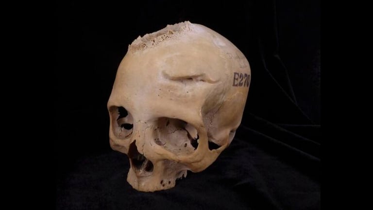 4,000-Year-Old Skull Reveals Ancient Egyptians' Advanced Cancer Surgery