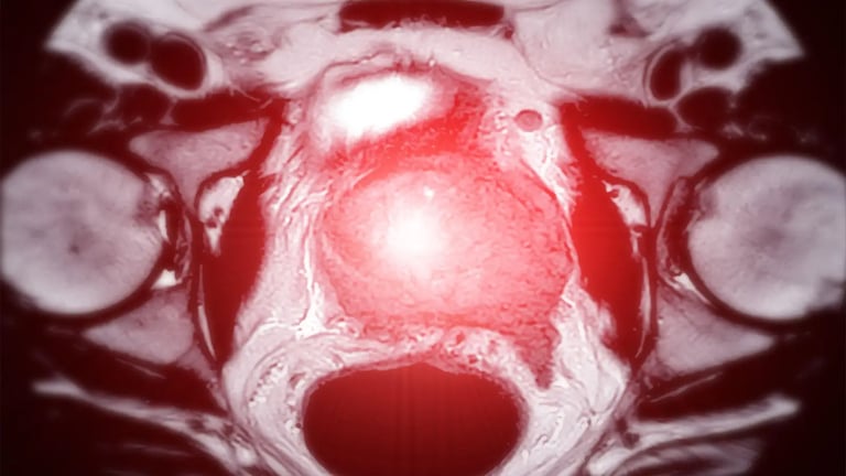 Revolutionary MRI Method Could Transform Prostate Cancer Screening with Faster, Cheaper, and Safer Scans