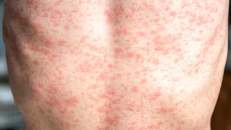 Urgent Measles Alert Issued for Sydney: New Cases Confirmed Amid Travel Concerns