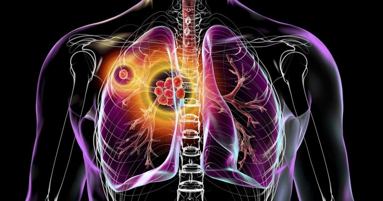 England's TB Cases Surge 13% in 2024, Exposing Urban Deprivation Link