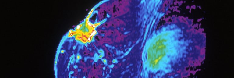 New Study Reveals Current Breast Cancer Referral Criteria Miss 95% of Future Cases in Women Under 50