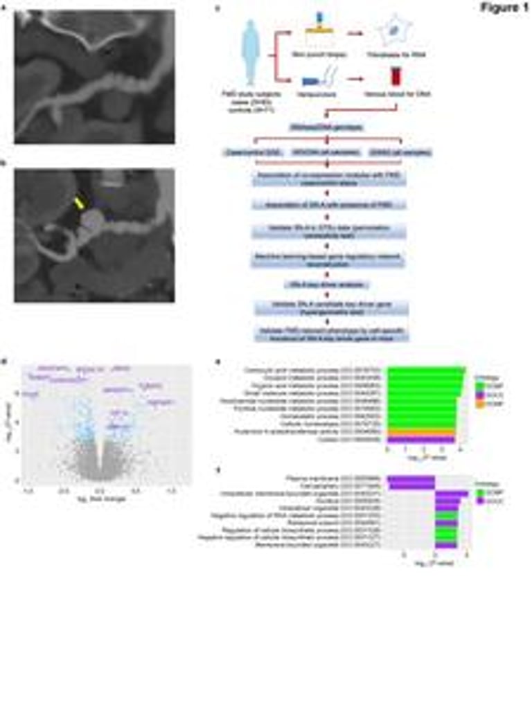 Mount Sinai Researchers Uncover Key Genetic Driver of Fibromuscular Dysplasia, Paving Way for Targeted Treatments