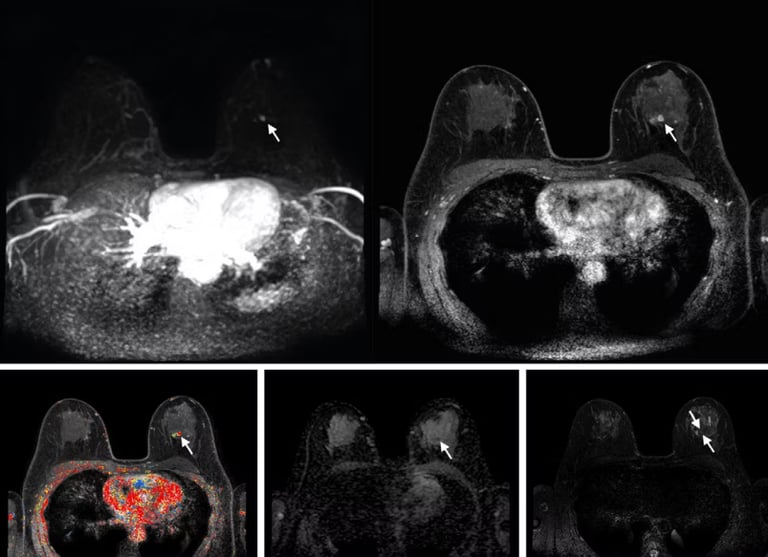 New Imaging Techniques Could Triple Cancer Detection in Women with Dense Breasts, Study Finds