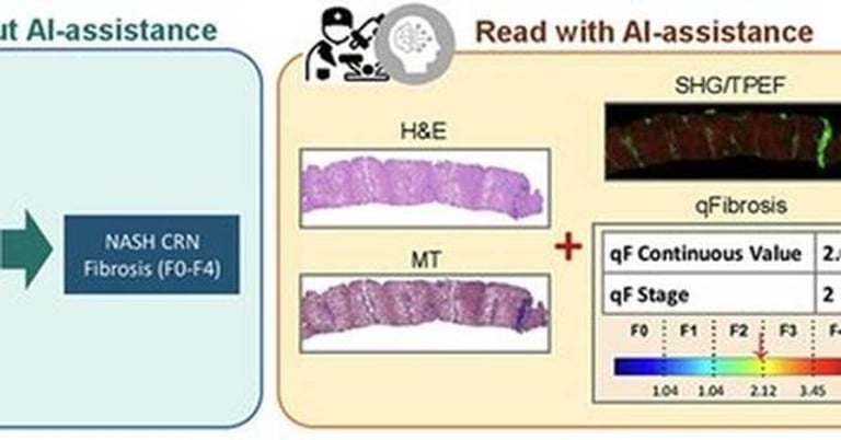 AI Revolutionizes Liver Fibrosis Evaluation in MASH, Enhancing Diagnostic Accuracy and Treatment