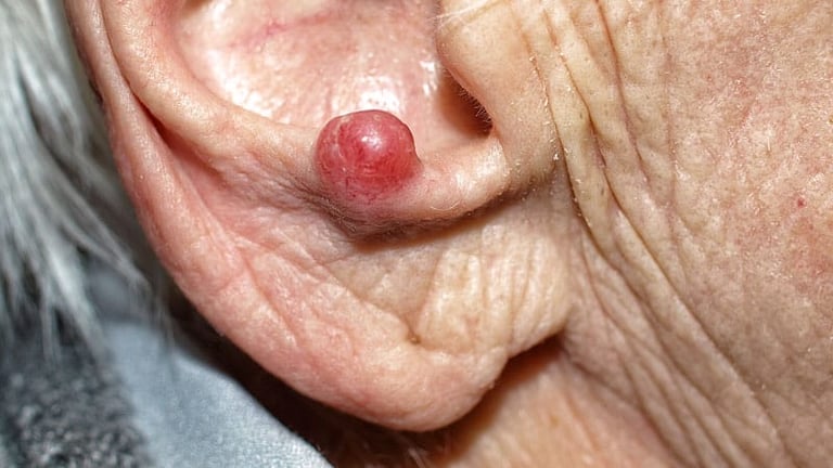 New Trials and Biomarkers Revolutionize Merkel Cell Carcinoma Care: Expert Insights on Future Directions