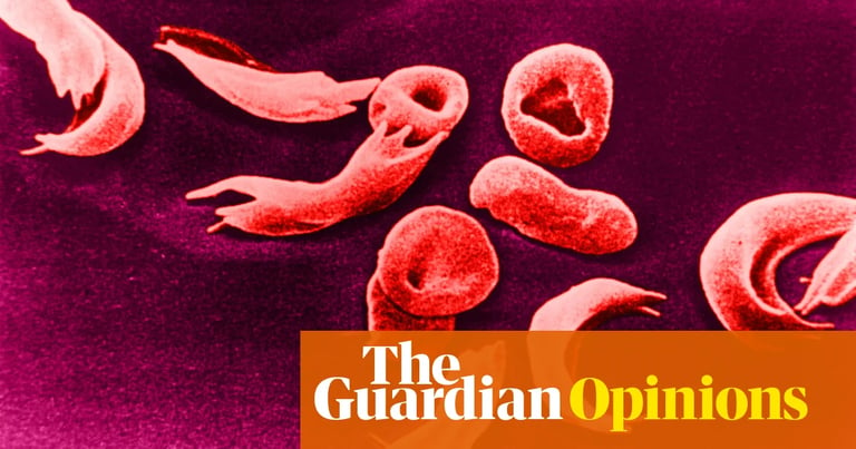 NHS Approves Breakthrough Gene Therapy for Sickle Cell, Sparks Hope Amid Systemic Inequality Concerns