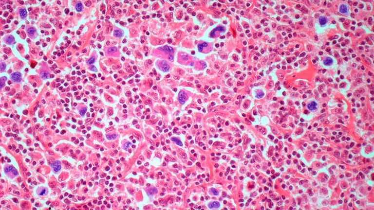 New Hodgkin Lymphoma Therapy Shows High Success, Reduces Need for Radiation